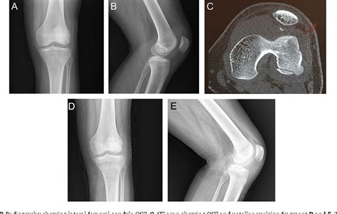 Figure 1 From Osteochondral Fracture In Weight Bearing Portion Of