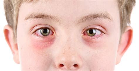 Pinkeyeconjunctivitis Signs Causes Diagnosis Treatment And Prevention