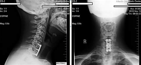 Cervical Fusion Recovery Times