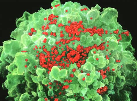 Two Hiv Infected Men Treated With Bone Marrow Transplants Have No Detectable Aids Virus The