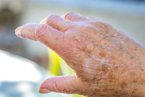 Old Age Spots On Skin Stock Photos Pictures And Royalty Free Images Istock