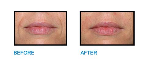 Nasolabial Folds Dublin Before And After Photo Perfectwhitesmilesie