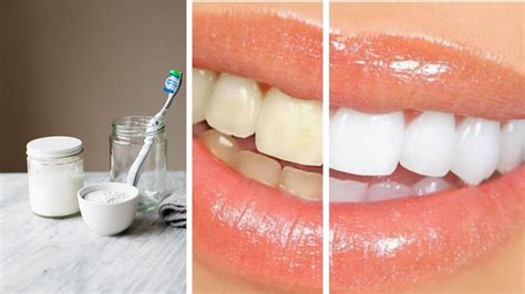 Teeth Whiter At Home In 2 Minutes Without Baking Soda Youtube