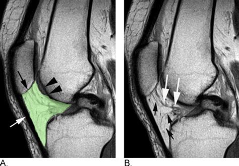 Magnetic Resonance Imaging Of Hoffas Fat Pad And Relevance For
