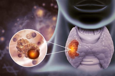 Cancerul Esofagian Cauze Manifestari Si Optiuni De Tratament Dr Max