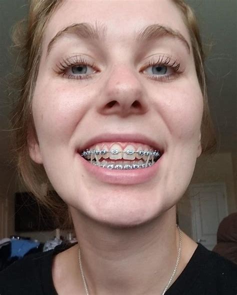braces girlswithbraces metalbraces elastics aparelho dental aparelho de dente ortodôntico