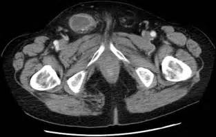 Gastrointestinal Stromal Tumour GIST Presenting As A Strangulated Inguinal Hernia With Small
