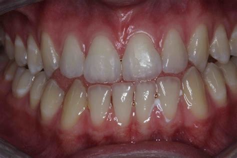 White Fillings Before And After Photos Front Tooth Composite Fillings