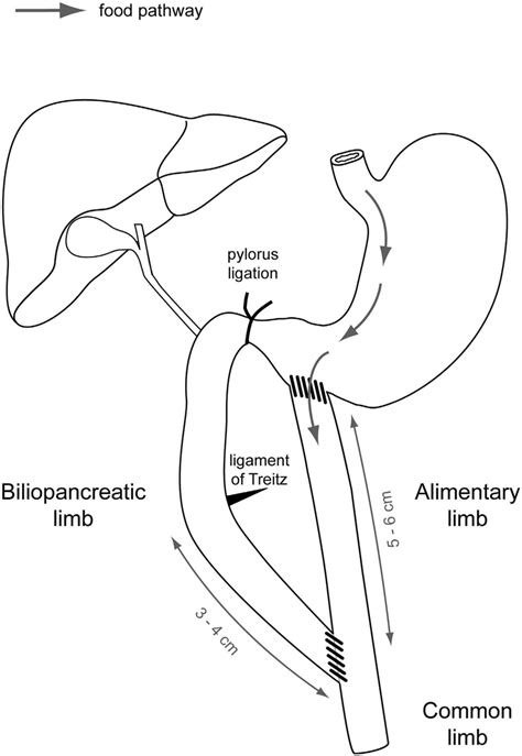 Ligament Of Treitz Diagram