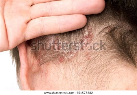 Detail Psoriasis Vulgaris Skin Disease Stock Photo Edit Now 451578682