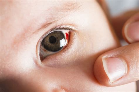 Bloodshot Eyes Causes In Babies