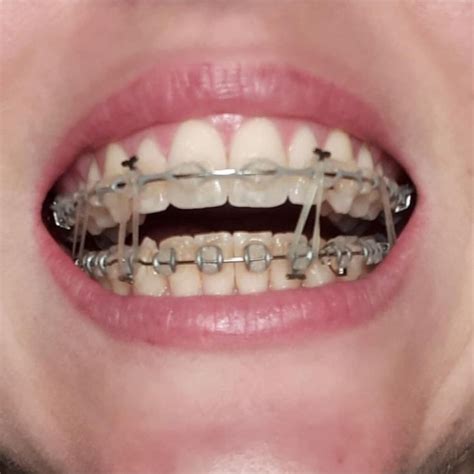 pin von elpotrillo31 auf mouth braces zahnspange kieferorthopädie zähne