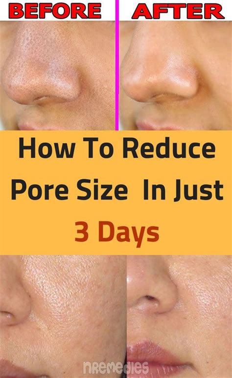 Reduce Pore Size With Home Remedies In Just 3 Days Fitness Beauty