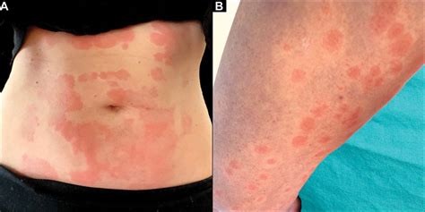 Skin Manifestations Of Covid Cleveland Clinic Journal Of Medicine