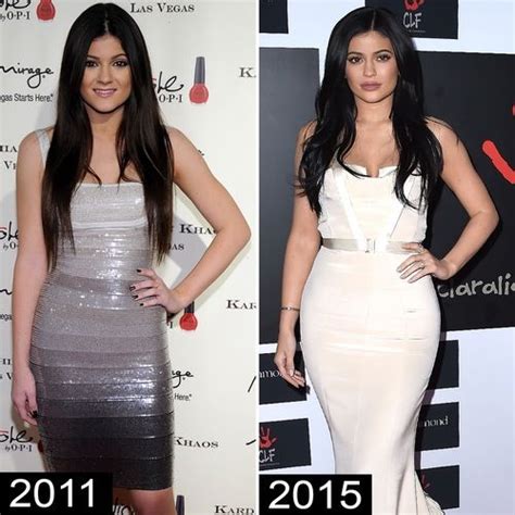 Kylie Jenners Plastic Surgeon Reveals All See Her Shocking