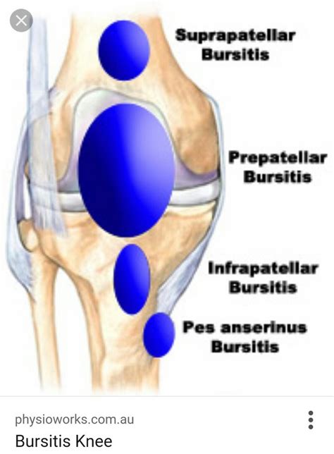 Knee Bursas Bursitis Knee Bursitis Prepatellar Bursitis
