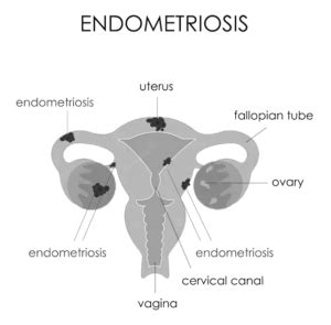 Understanding Endometriosis Symptoms Diagnosis And Treatment SJL