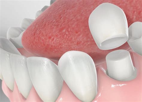 10 Pros And Cons Of Dental Crown Procedures