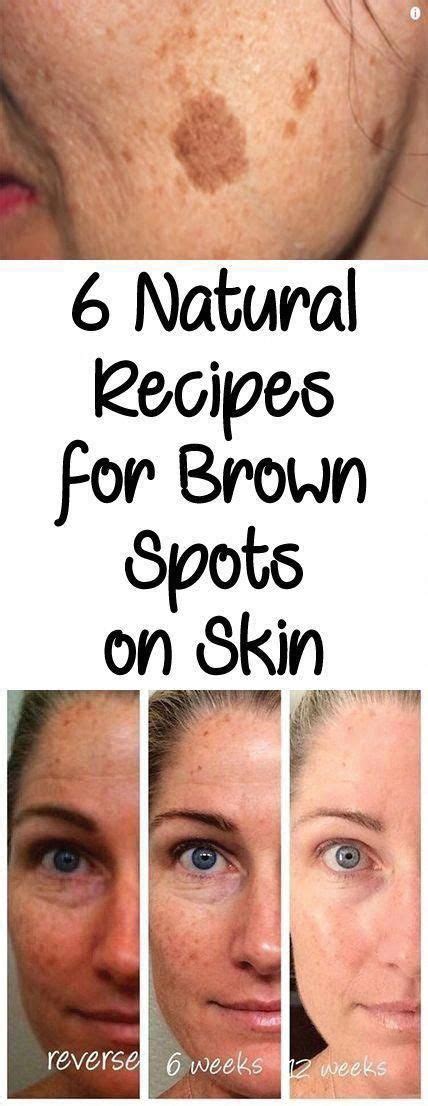 Find Out Who Is Worried About Remove Brown Spots And Why You Should Pay