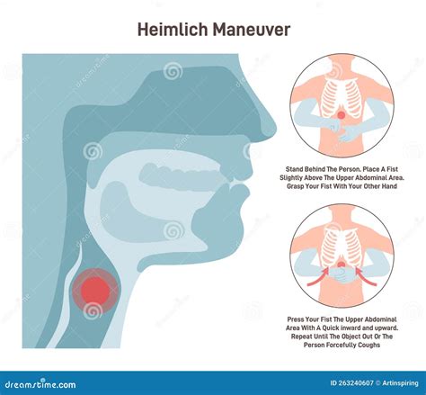 Choking First Aid Heimlich Maneuver Procedure To Remove A Foreign Cartoon Vector