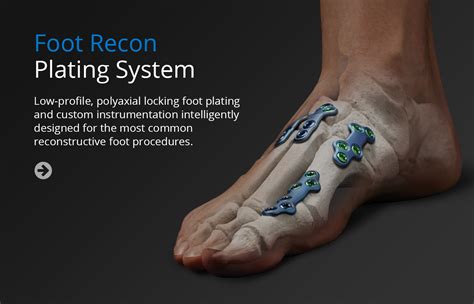 Implant Systems Unite Foot And Ankle