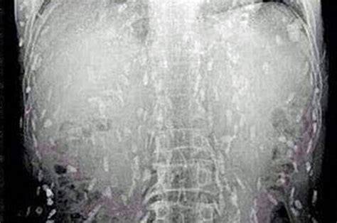 Man Infested With Worms In Terrifying X Ray Pictures Daily Star