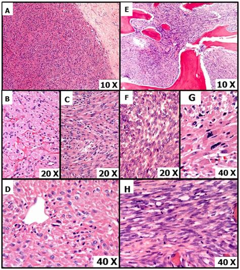 Primary Malignant Perivascular Epithelioid Cell Neoplasm Pecoma Of