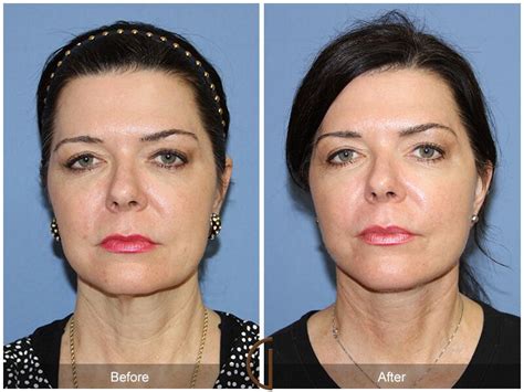 Facelift Fifties Before And After Photos Patient 72 Dr Kevin Sadati