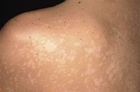White Spots On Body And How To Treat Them