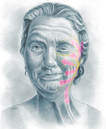 Hemifacial Spasm Microsurgical Treatment Shown In D