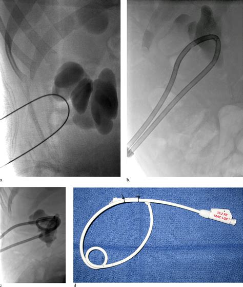 A Durable Percutaneous U Tube Nephrostomy For Management Of A