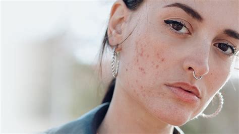 What Your Breakouts Tell You About Your Acne Everyday Health