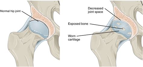 Structural features, ligaments, and associated tendons of the shoulder joint drag the labels onto the diagram to identify the structural features, ligaments, and associated tendons of the shoulder join acromioclavicular ligament glenohumeral ligaments glenoid cavity iii glenoid labrum tendon of biceps brachii muscle articular capsule coracohumeral ligament Synovial Joints · Anatomy and Physiology