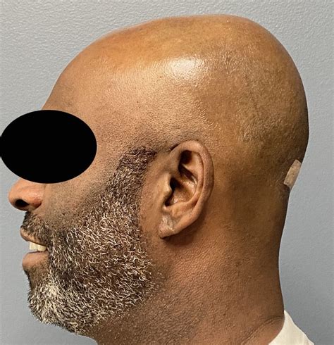 Plastic Surgery Case Study Custom Skull Implant Augmentation For Male