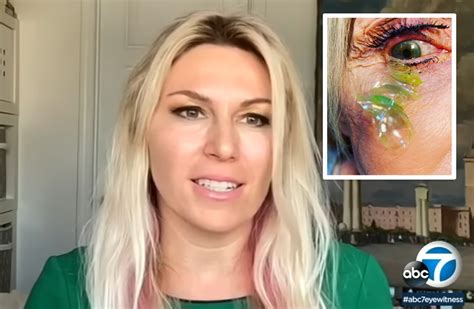 Omg Ophthalmologist Discovered Her Patient Had 23 Contact Lenses Lodged Underneath Her Eyelid