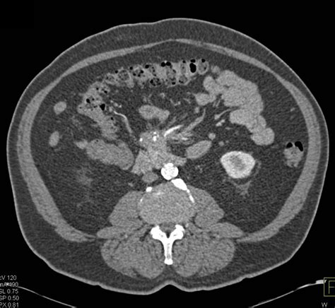 Carcinoid Tumor With Encased Superior Mesenteric Artery Smasuperior