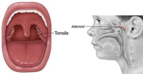 Tonsils And Adenoids