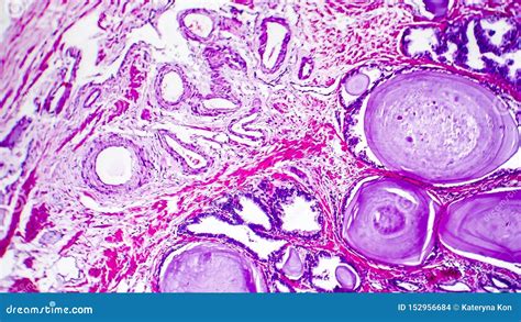 Histopathology Of Prostate Gland Hyperplasia Stock Photo Image Of