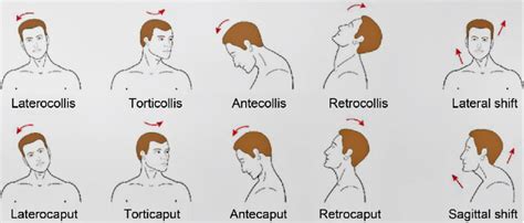 Cervical Dystonia Spasmodic Torticollis Cdc