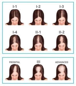 What Is Female Pattern Hair Loss TRICHOLOGY CENTRE