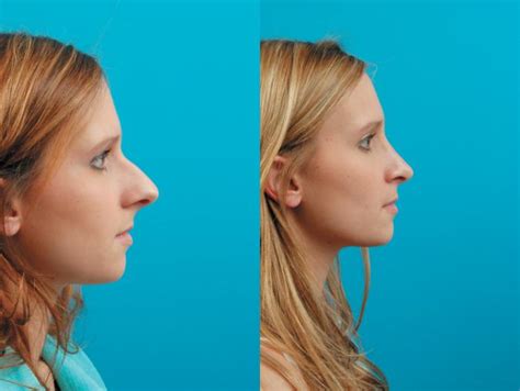 Rhinoplasty Before And After Photo Gallery West Des Moines And Ames Ia