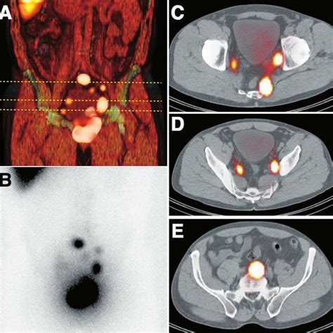Pdf Contribution Of Spectct Imaging To Radioguided Sentinel Lymph