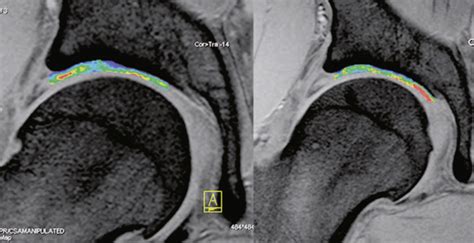 Magnetic Resonance Imaging Of The Hip Joint Musculoskeletal Key