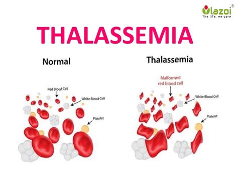 Thalessemia Overview Symptoms Complications Risk Factor Cause