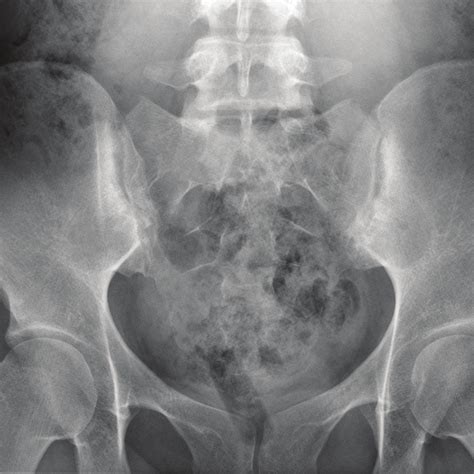 x‑ray of the pelvis of a 31‑year‑old female patient with a history of download scientific
