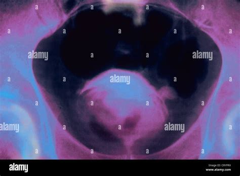 Prostate Cancer X Ray Stock Photo Alamy