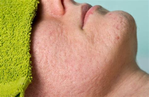 How To Get Rid Of Pitted Acne Scars Marqueus Draper