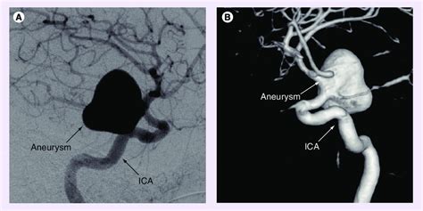 Giant Posterior Communicating Artery Aneurysm A Digital Subtraction Download Scientific