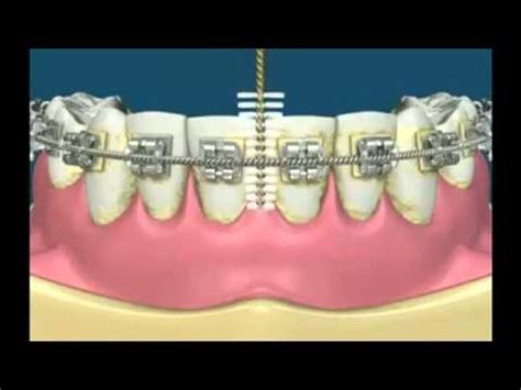 The stains can be because of inability to brush teeth properly because of brackets and wire. Proxy Brush with Braces - YouTube