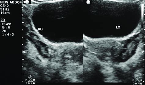 Ultrasound Image Of Both Ovaries Showing Multiple Follicles Arranged